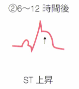 ST上昇