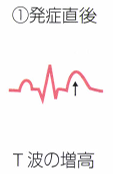 T波増高